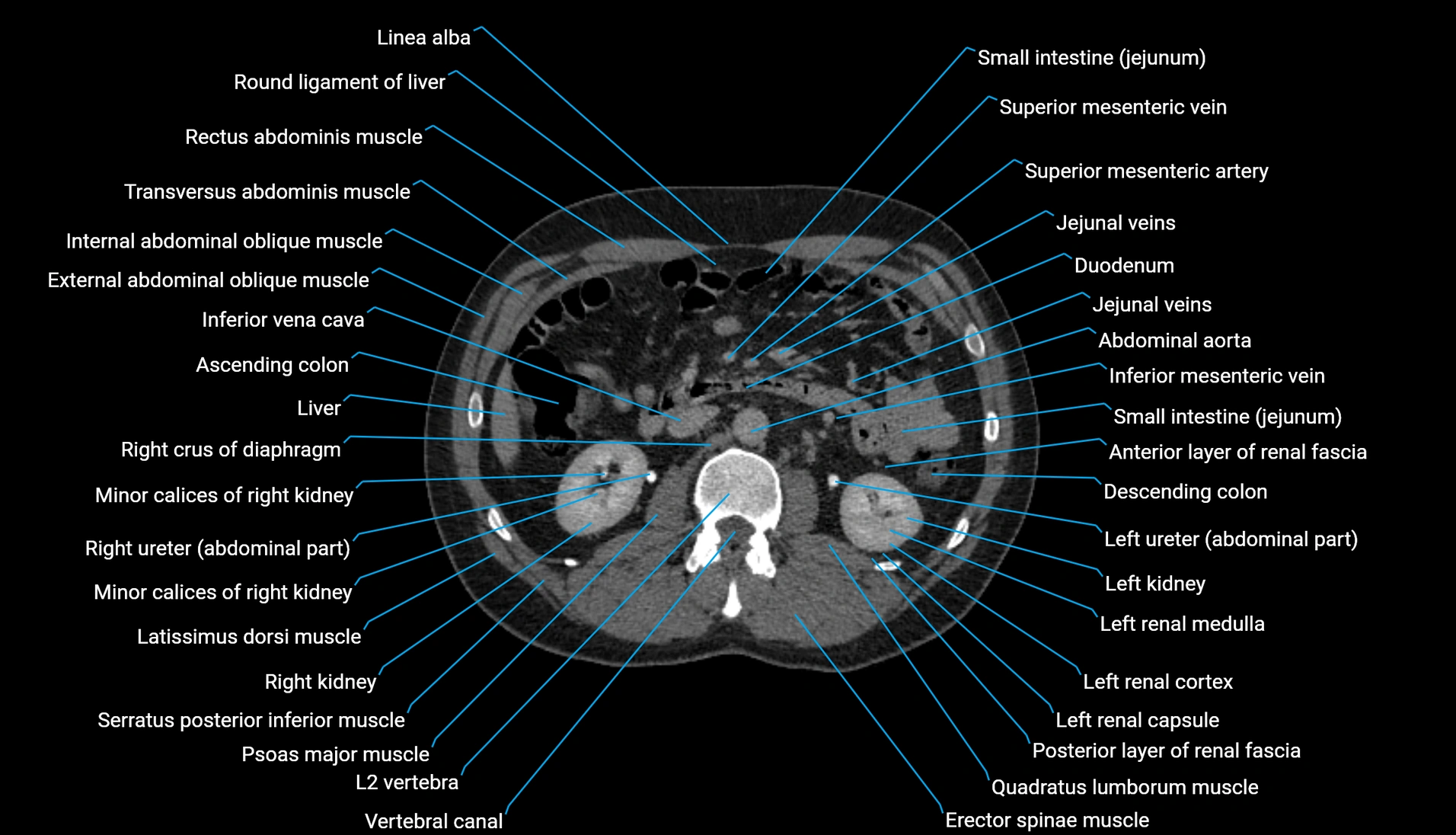 CT urogram axial cross sectional anatomy  labelled radiology image-00111.webp